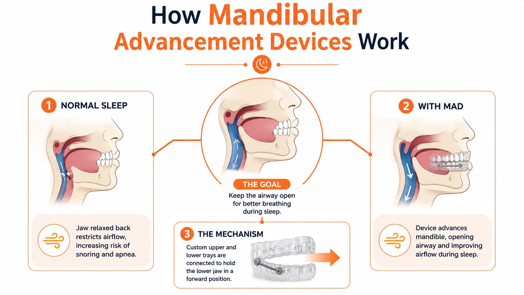 A diagram illustrating how mandibular advancement devices (MAD) work to prevent snoring and sleep apnea.