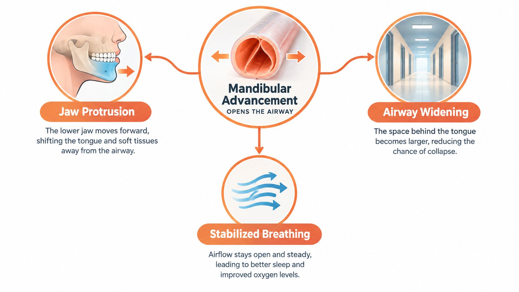 A diagram illustrating how a mandibular advancement device helps stabilize breathing by widening the airway.